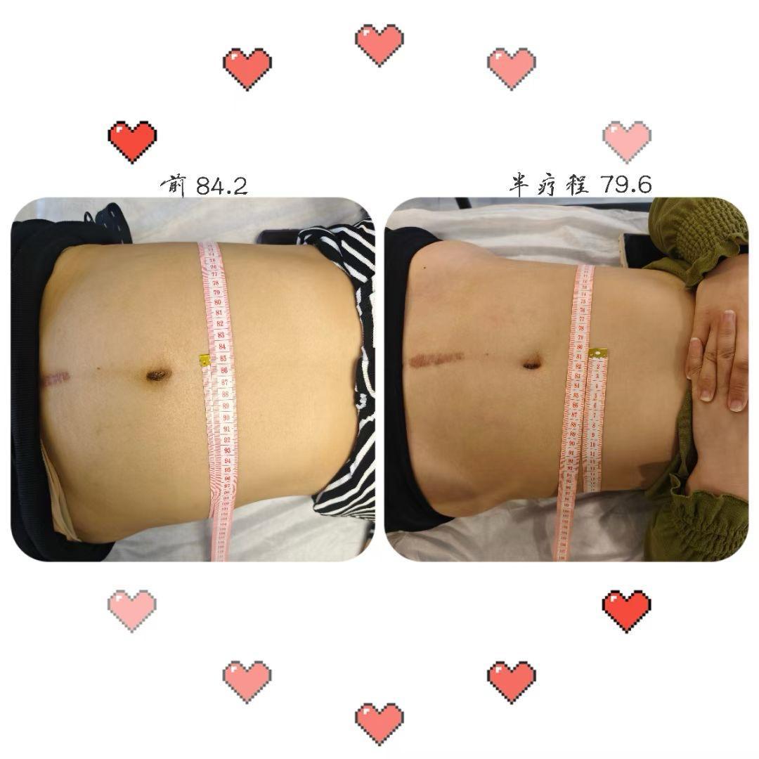 Before and after — Abdominal Care 01 | SKYE Aesthetics