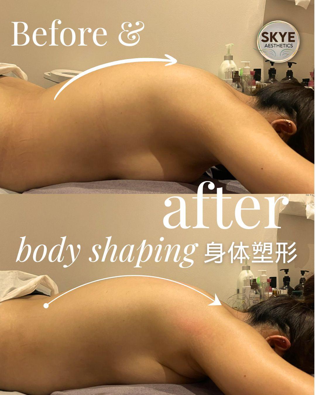 Before and after body shaping result from Skye Aesthetics