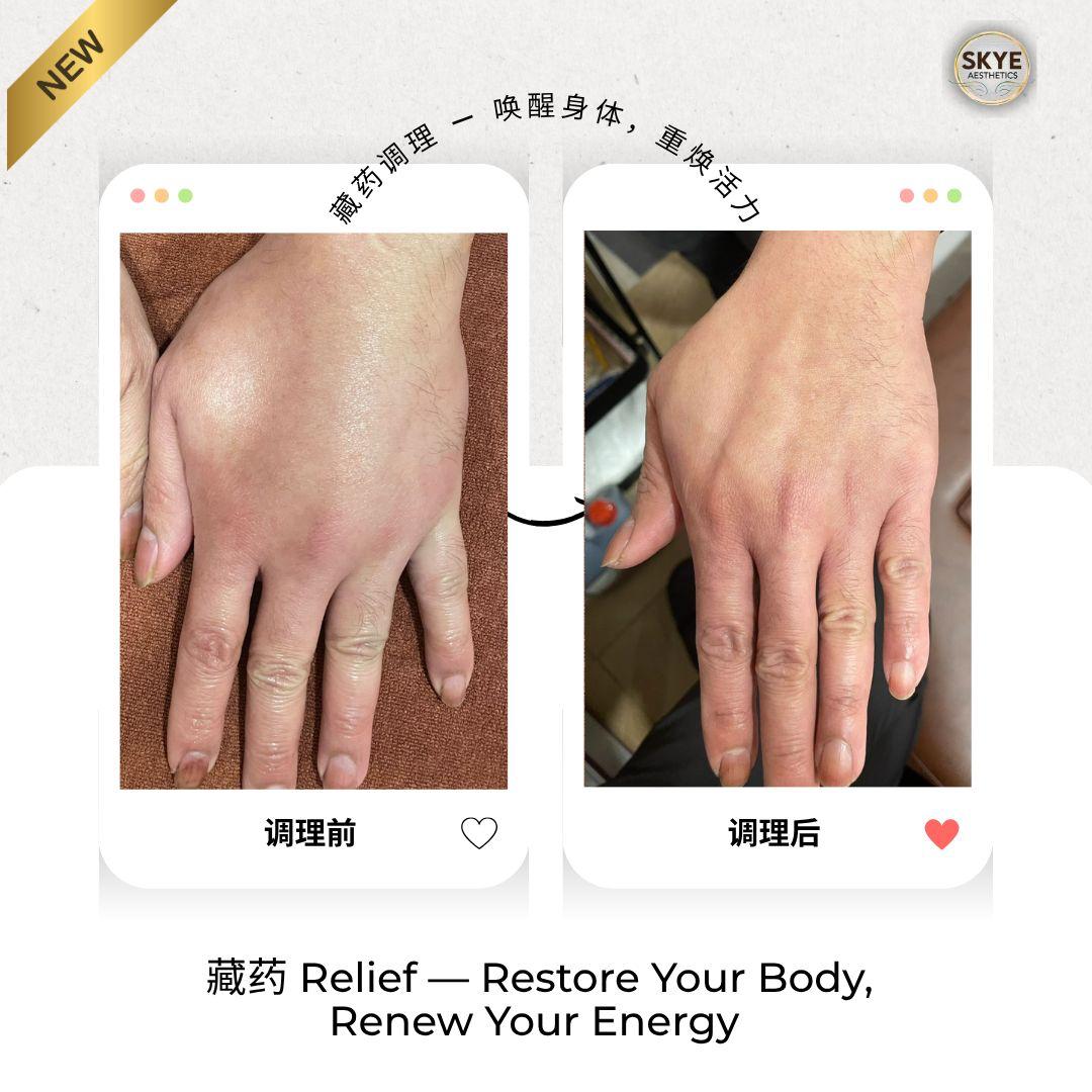 Before and after — Hand Care 01 | SKYE Aesthetics