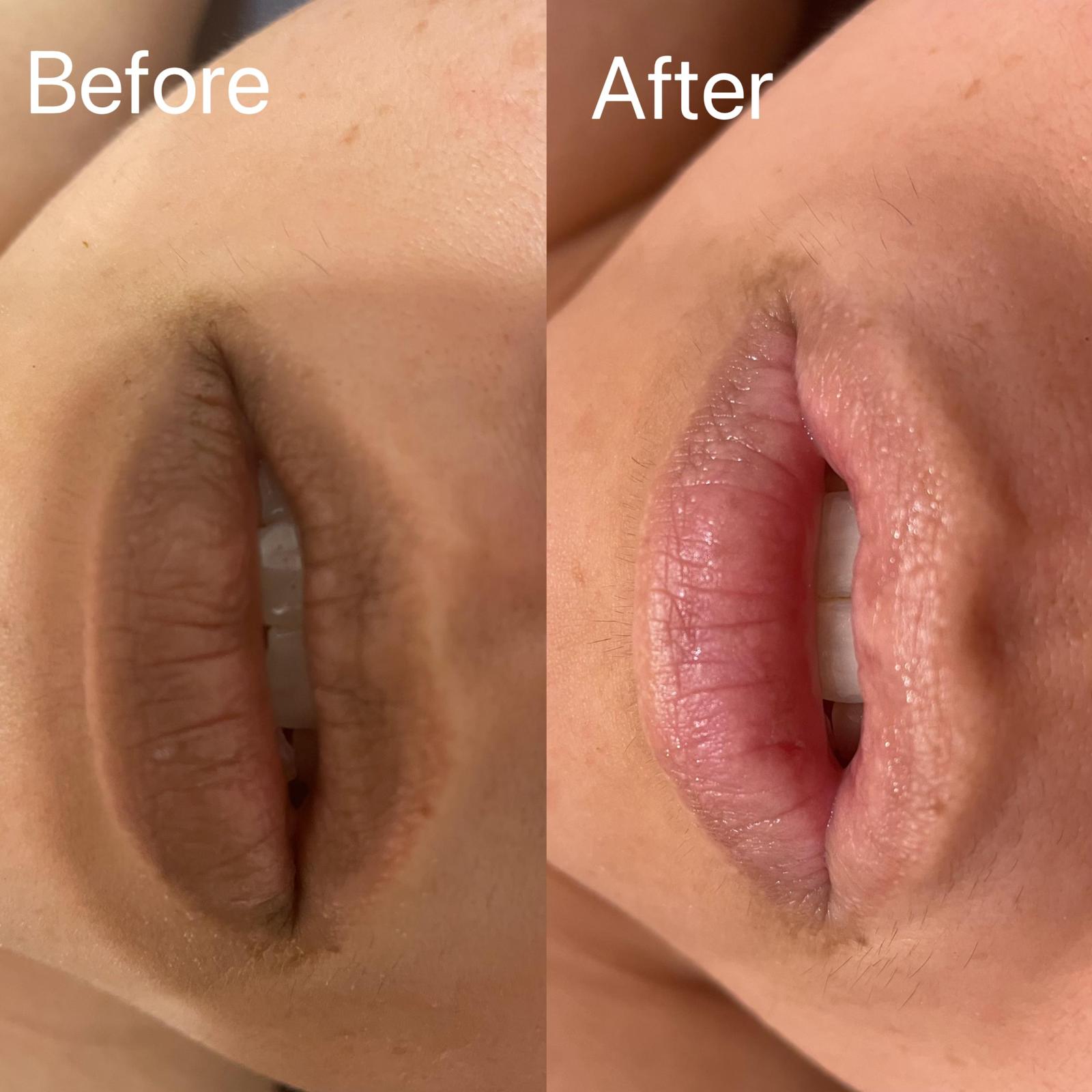 Before and after — Lip Care 01 | SKYE Aesthetics